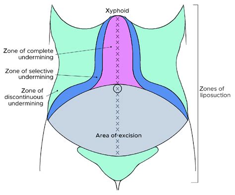 Modern abdominoplasty techniques advocate narrow undermining of the... | Download Scientific Diagram