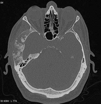 Fibrous Dysplasia Skull Bone Scan