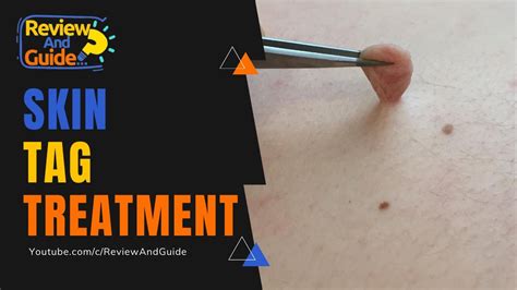 Skin Tags (Acrochordons) Causes, Treatment and Removal - YouTube