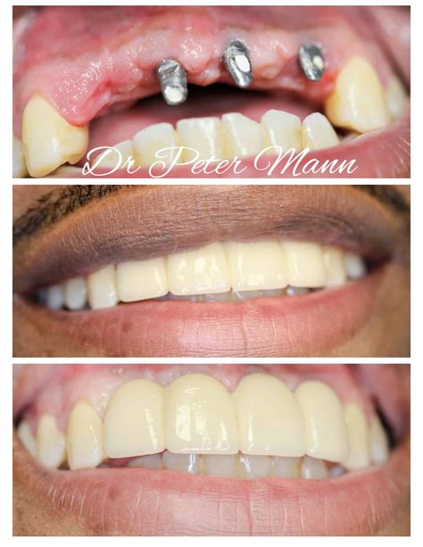 Dental Implants Before And After Photos | NYC Dentist