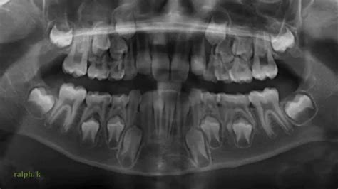 Image result for mixed dentition panoramic xray | X ray, Panoramic, Teeth