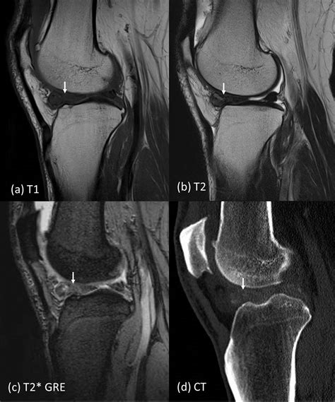 T1 Vs T2 Mri Knee