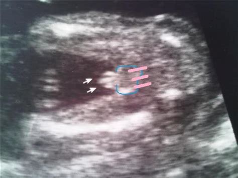 Plz help! Does 3 lines definitley mean a girl? in Ultrasound Gender Prediction Forum