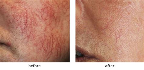 spider veins | Laser Hair Removal Center, Style MedSpa