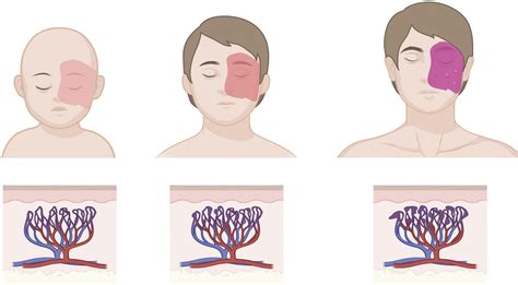 Weber Syndrome