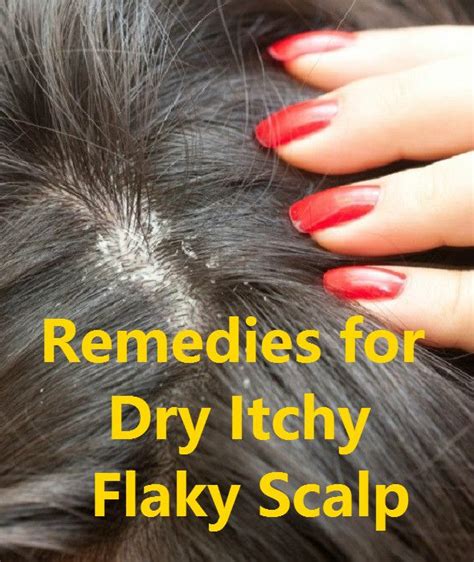 Best 25+ Itchy flaky scalp ideas on Pinterest | Treatment for dry scalp ...