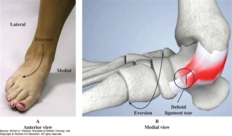 Deltoid Ligament Sprain | AccessMedicine Network