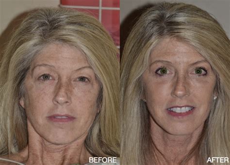 Treatment for Lower Eyelid & Dark Circles in Rochester, New York