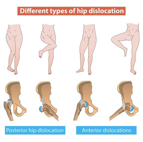 Expert Treatment for Hip Dislocation | Sforzo Dillingham