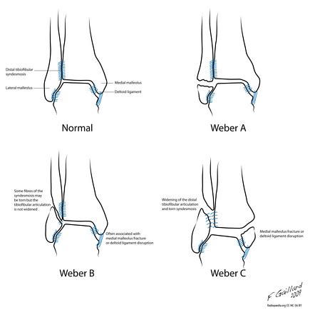 Weber classification of ankle fractures | Radiology Reference Article ...