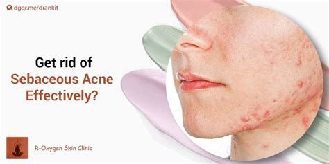 Sebaceous Acne: How to get rid of it effectively | Get rid of Acne