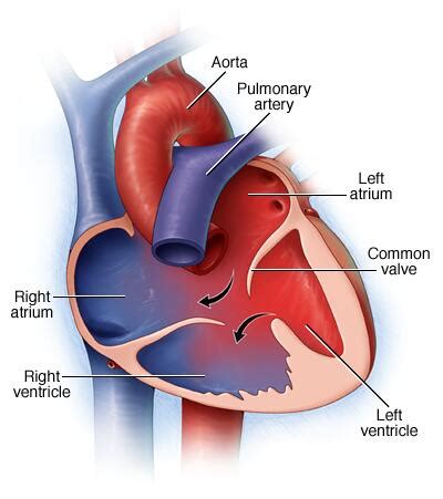 Atrioventricular Canal Defect: Causes, Symptoms Treatment, 57% OFF