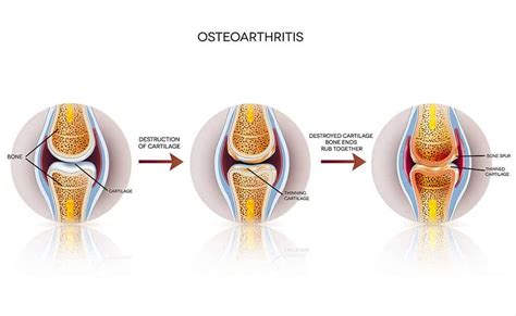 DePuy Synthes Attune® Knee Replacement Lawyers | Martin, Harding & Mazzotti, LLP