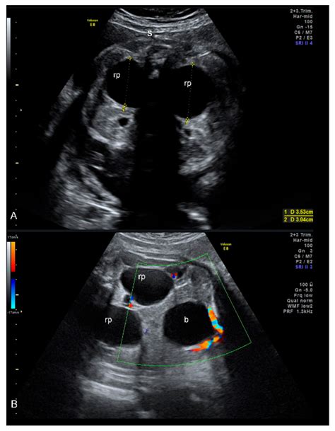 Hydronephrosis Grading Ultrasound