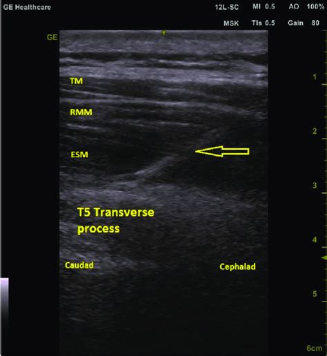 Erector spinae block anatomy. The ultrasound probe placed over the T5 ...