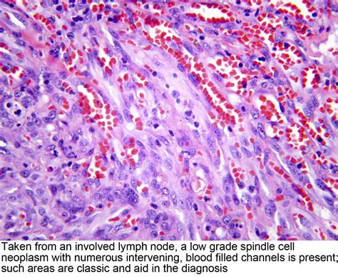 Pathology Outlines - Kaposi sarcoma