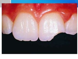 Management of Ellis Class IV Fracture | PPT