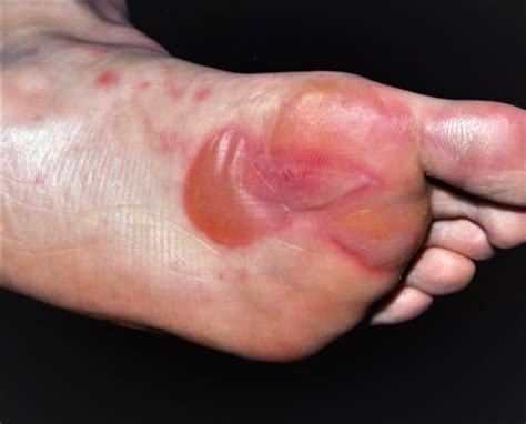 Blister on Foot - Causes and How To Treat Foot Blisters