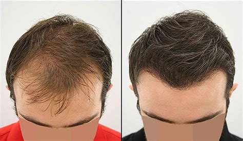 Hair transplant in Iran| The success rate of Hair transplant in men & women