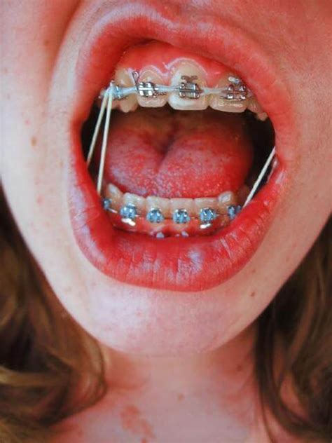 Braces Rubber Bands - Purpose, Effects, Downsides, Results