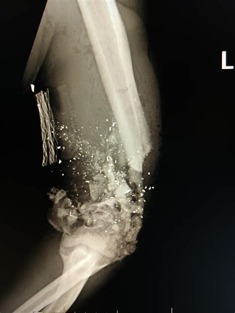 Daily Self Defense: Hollow Point VS. Distal Humerus