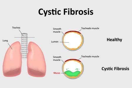 Cystic Fibrosis: Causes Symptoms Diagnosis and Treatment