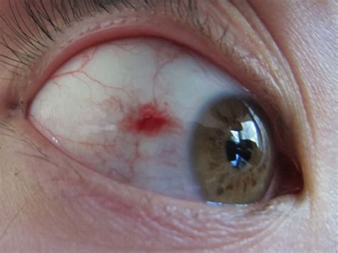 Subconjunctival Hemorrhage: Symptoms, Causes, Treatments