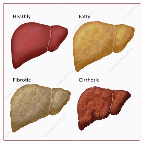 Stages of Liver Damage, Illustration - Stock Image - C027/6480 - Science Photo Library