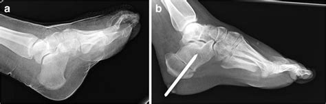 Calcaneal slide osteotomy in an 18-year-old woman with pes cavus, left... | Download Scientific ...