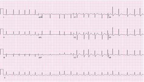 Cardiology 101 – Atrial Fibrillation (USMLE) : Causes, Symptoms, Diagnosis, and Treatments ...