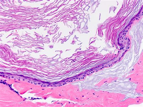 Pilar Cyst Histology