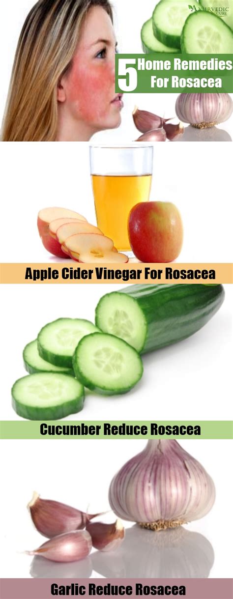 Top 5 Home Remedies For Rosacea - Natural Treatments And Cures ...