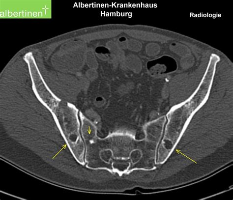 CT scan: Osteolysis on the pelvic bone, plasmocytoma - DocCheck