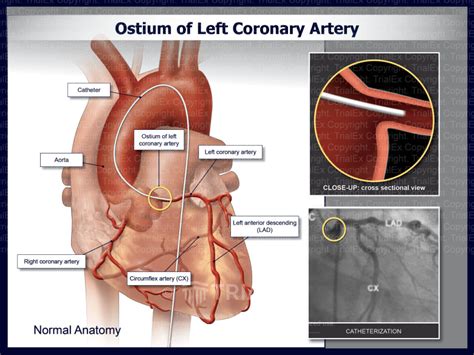 Ostium of Left Coronary Artery - TrialQuest Inc.