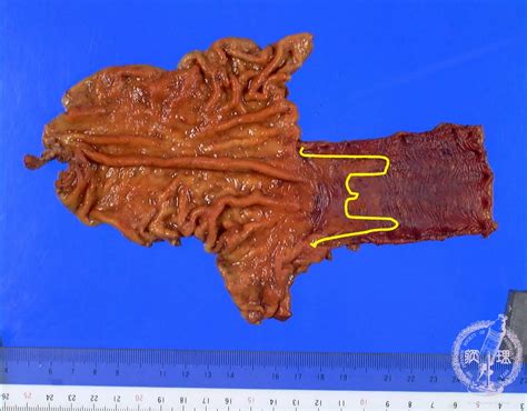 Barretts Esophagus Histology