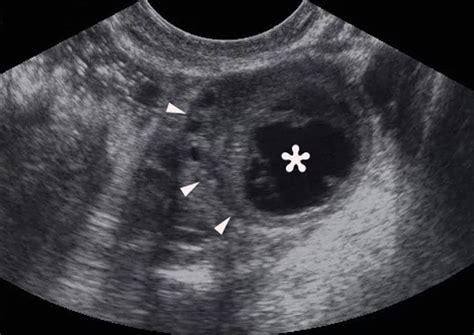 Hemorrhagic cyst, complex cyst | Radiology, Sonography, Ultrasound