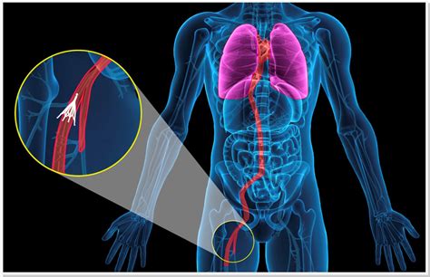 filtro-de-veia-cava-dr-daniel-benitti-cirurgiao-vascular | Cirurgião ...