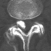 (PDF) Facet cyst in the lumbar spine: Radiological and ...