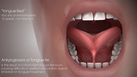 Tongue-tie Shown & Explained Using A Medical Animation