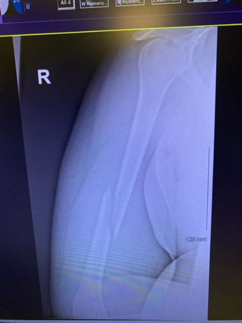 Midshaft humerus fracture Professor Ali Noorani