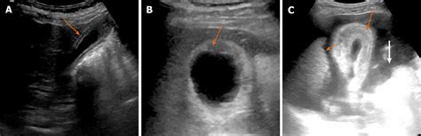 Imaging-based algorithmic approach to gallbladder wall thickening