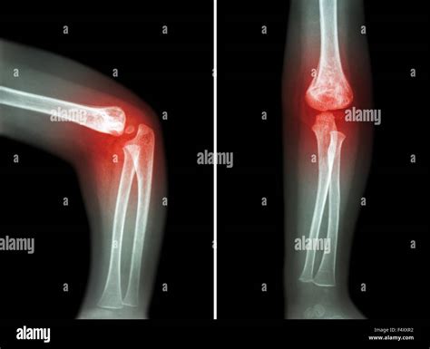 Rheumatoid arthritis , Gouty arthritis ( film x-ray child 's elbow ...