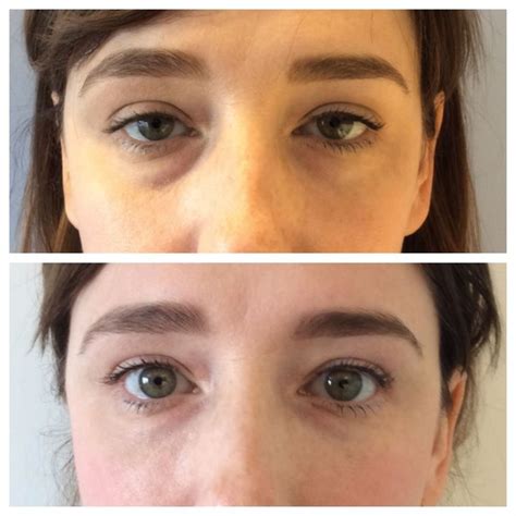 Another great before/after of non-surgical under eye injections! | Gold ...