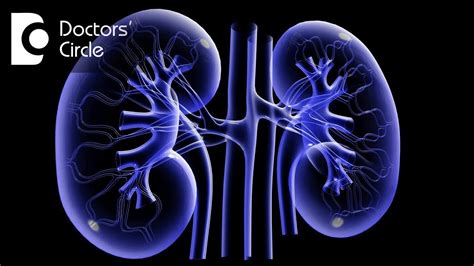 How soon is one discharged & complications after Lithotripsy? - Dr ...