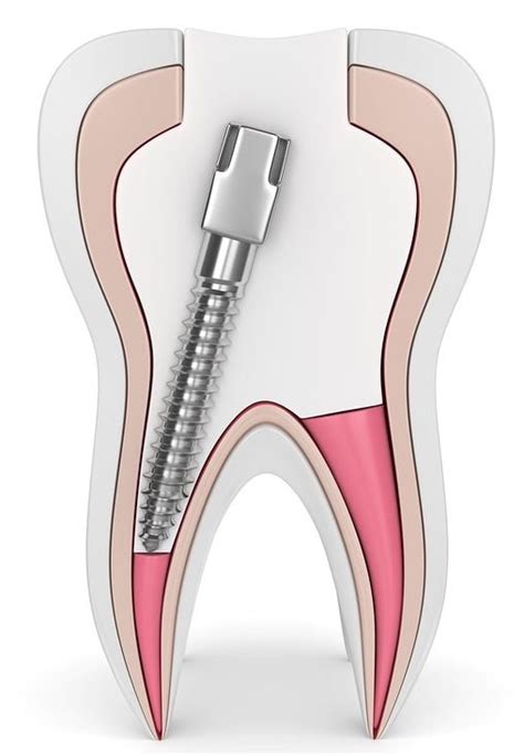 What is a Post-Core? | Mi DENTAL