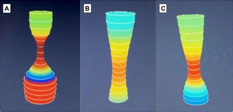 Endoluminal Functional Imaging Demonstrates Need for Myotomy During Epiphrenic Diverticulectomy ...