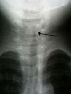 Medical Short Notes: Steeple sign-croup Diag.