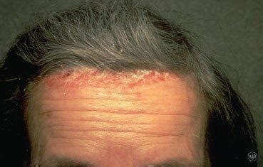 Scalp psoriasis: Foothill Dermatology Medical Center: Dermatology