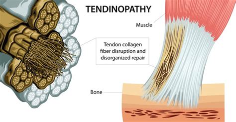 Managing Tendon Pain - reactive