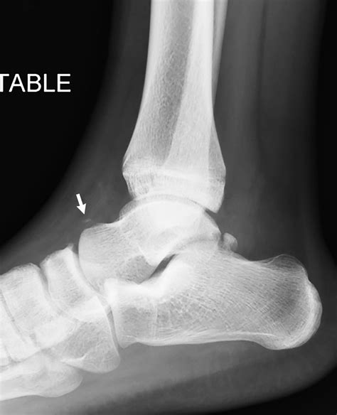 My achin’ feet: Talus fracture | Radiology Key